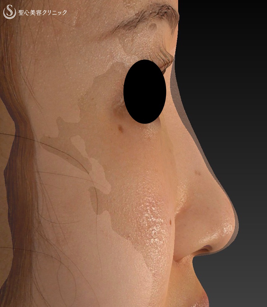【20代女性・自然に鼻筋を通す】鼻プロテーゼ挿入＋耳介軟骨移植（鼻尖形成）（術後1ヶ月） After 