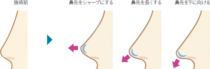 3D鼻尖用PCLドーム（オステオポア）を使った鼻尖形成の特長