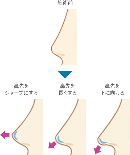 3D鼻尖用PCLドーム（オステオポア）を使った鼻尖形成の特長