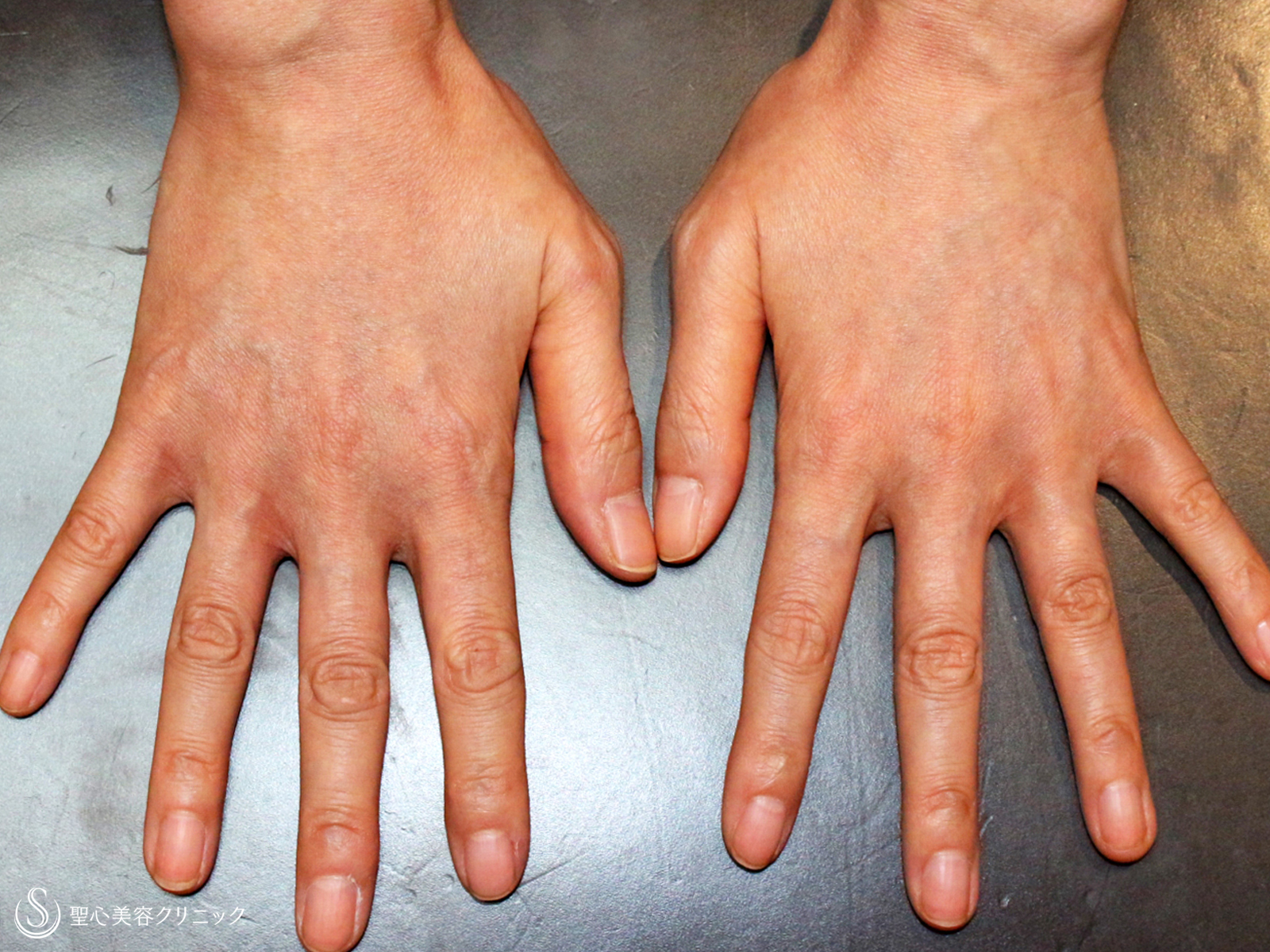 【50代女性・「手の甲」究極のアンチエイジング】プレミアムPRP皮膚再生療法（7ヶ月後） After 