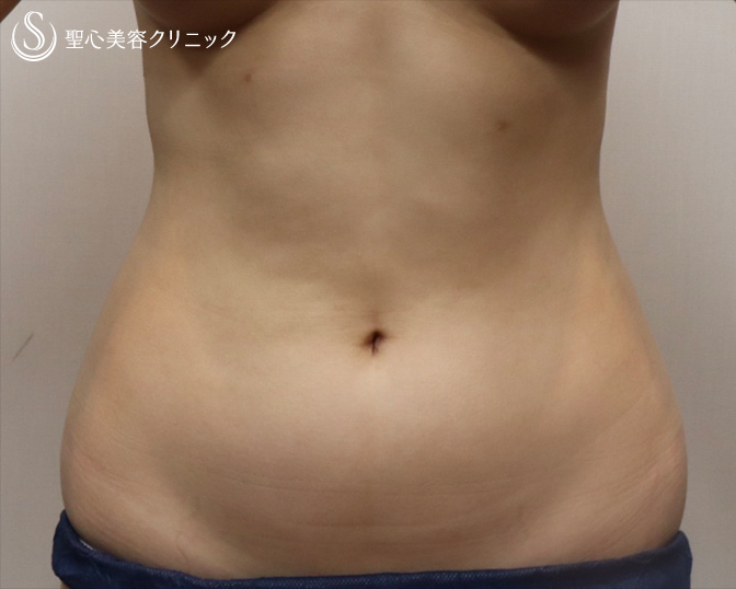 【女性・凹凸なく綺麗なお腹に】ベイザー脂肪吸引（術後1週間） Before 