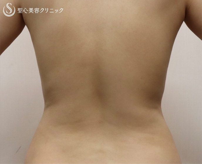 【女性・凹凸なく綺麗なお腹に】ベイザー脂肪吸引（術後1週間） Before 