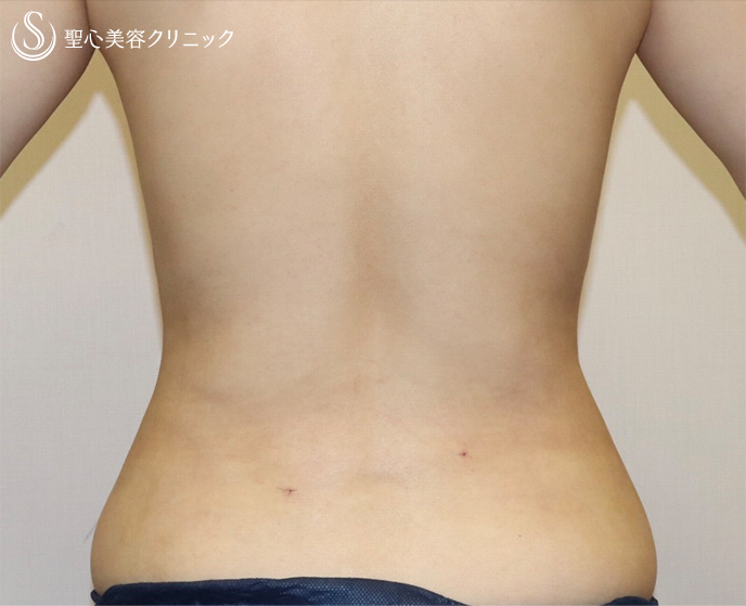 【女性・凹凸なく綺麗なお腹に】ベイザー脂肪吸引（術後1週間） After 