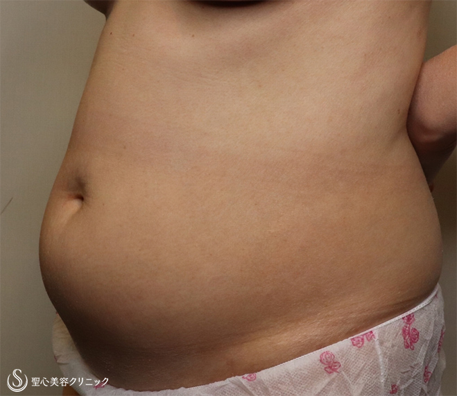 【50代女性・ポッコリ出たお腹を解決】 ベイザーリポ脂肪吸引（術後1ヶ月） Before 