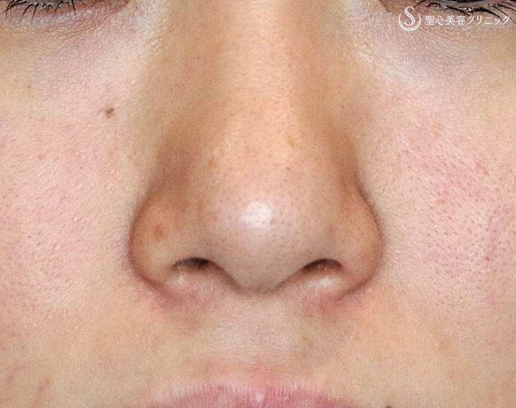 【20代女性・ダンゴ鼻＆大きな小鼻】鼻尖縮小術+α法＆小鼻縮小術+α法の長期経過（3年後） 症例写真 美容