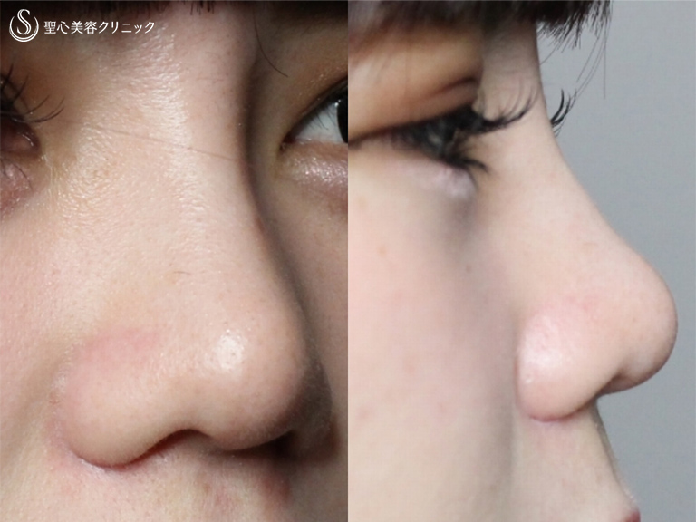 【20代女性・鼻筋を通して小さく整った鼻に】プロテーゼ+鼻尖縮小+耳介軟骨移植+小鼻縮小（術後1ヶ月） After 