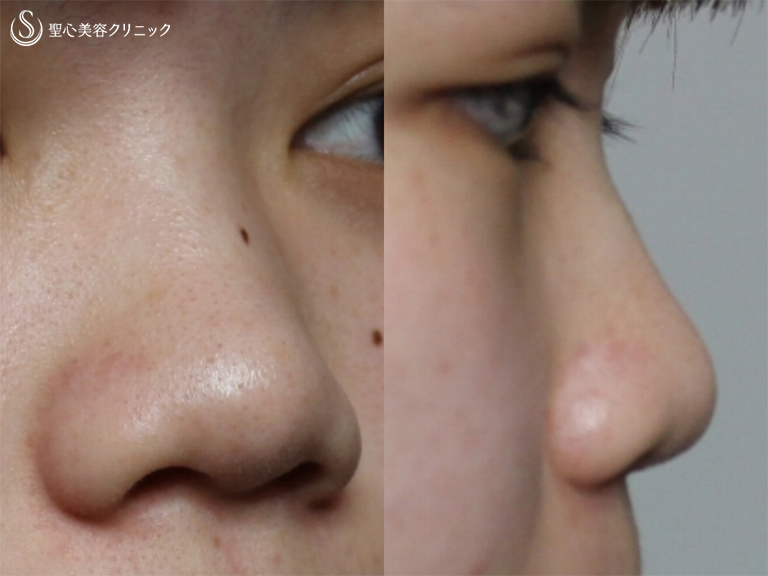 【20代女性・鼻筋を通して小さく整った鼻に】プロテーゼ+鼻尖縮小+耳介軟骨移植+小鼻縮小（術後1ヶ月） Before 