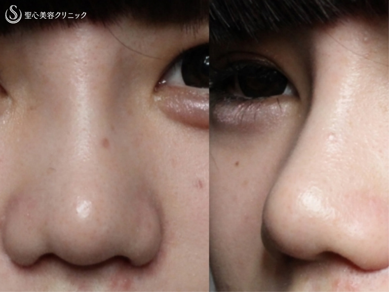 【20代女性・鼻筋を通して小さく整った鼻に】プロテーゼ+鼻尖縮小+耳介軟骨移植+小鼻縮小（術後1ヶ月） After 