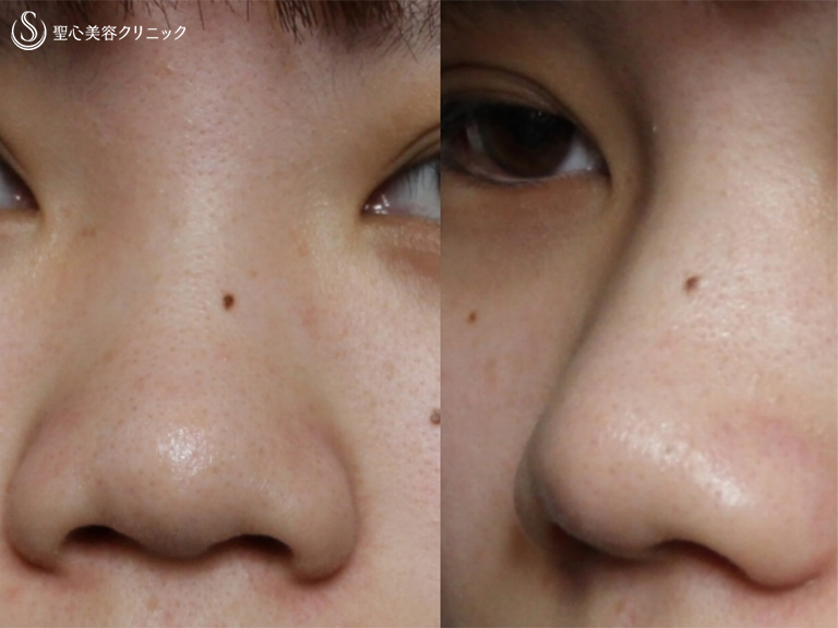 【20代女性・鼻筋を通して小さく整った鼻に】プロテーゼ+鼻尖縮小+耳介軟骨移植+小鼻縮小（術後1ヶ月） Before 