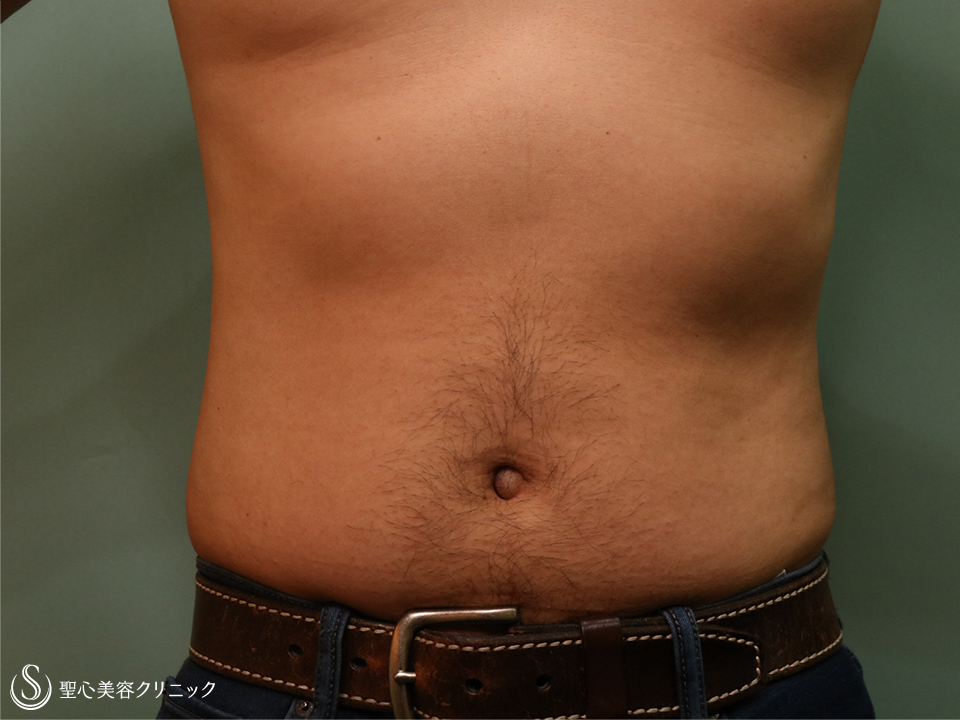 【30代男性・切らずに腹部痩せ】リポセル腹部（1.5ヶ月） After 