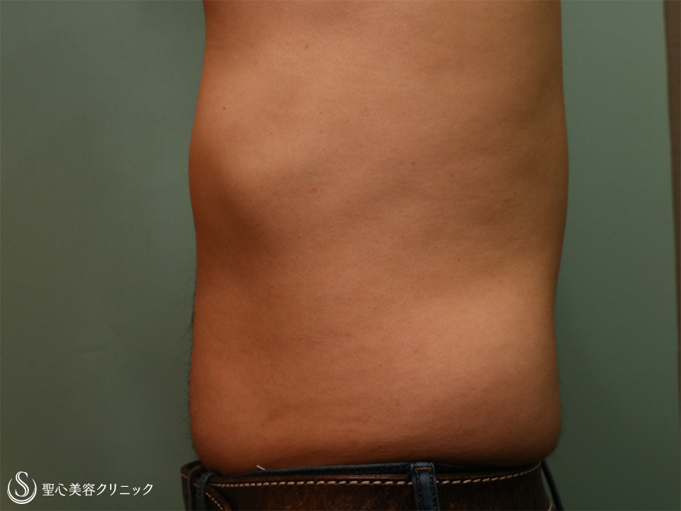 【30代男性・切らずに腹部痩せ】リポセル腹部（1.5ヶ月） After 