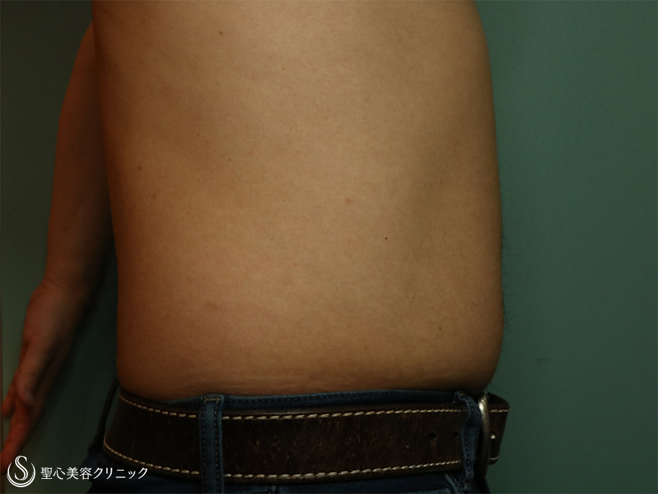 【30代男性・切らずに腹部痩せ】リポセル腹部（1.5ヶ月） Before 