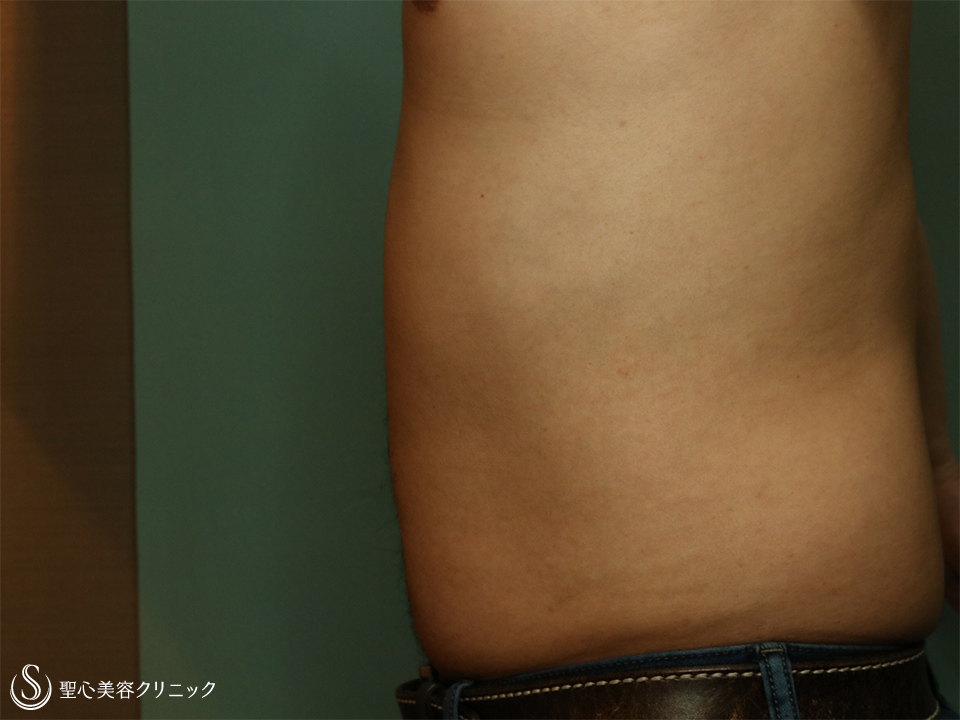 【30代男性・切らずに腹部痩せ】リポセル腹部（1.5ヶ月） Before 