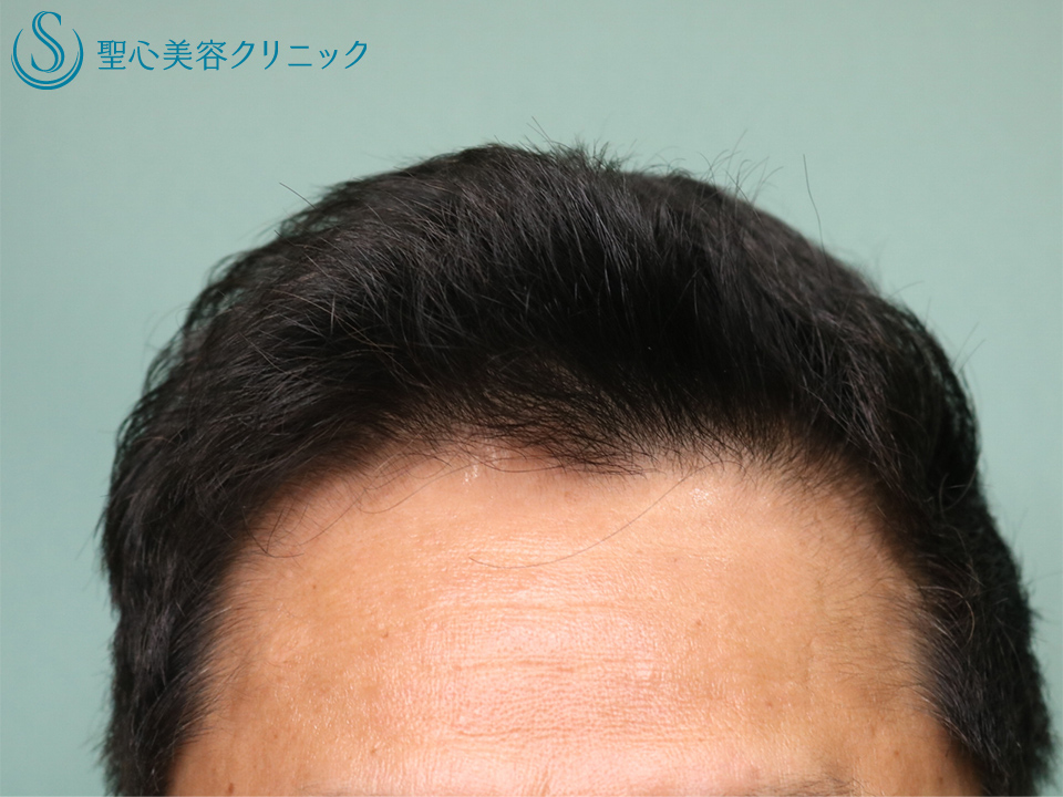 【50代男性・薄毛治療でハリコシも改善】ミノキシジルタブレット+ビビスカル プロ（3ヶ月後と6ヶ月後） After 