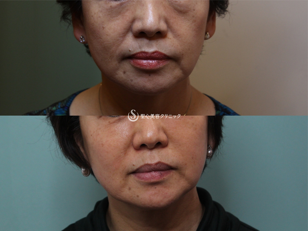 【60代女性・目の下や顔のたるみを長期的に改善】プレミアムPRP、ドクターハイフ（ウルセラシステム）2回後（9年後） After 