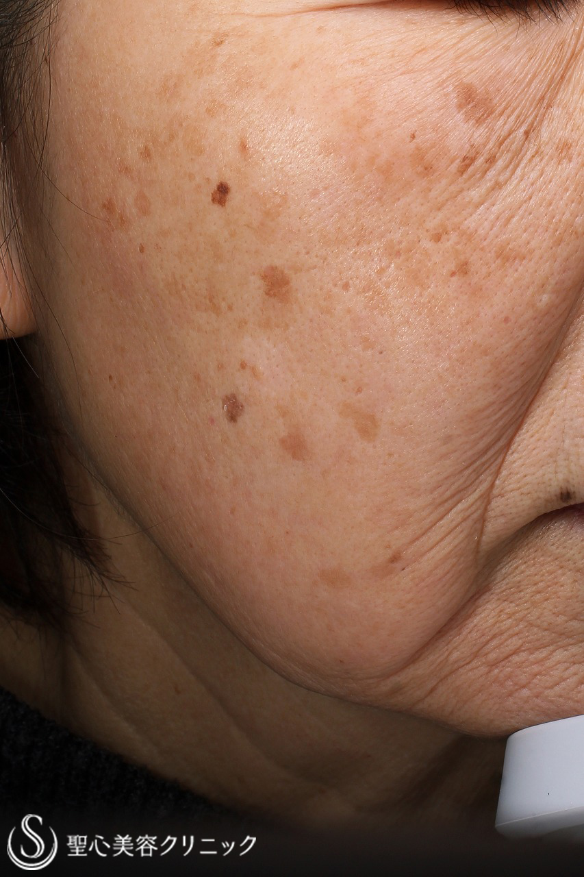 【60代女性・顔のシミ】ライムライト1回+ヒト脂肪幹細胞上清クリーム・Nトレチノイン・HQエッセンス外用（1ヶ月後） 症例写真 美容