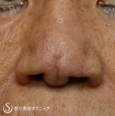 【60代女性・鼻尖の傷】傷跡修正（2ヶ月後） Before 