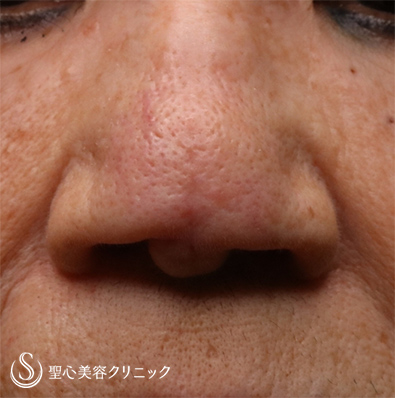 【60代女性・鼻尖の傷】傷跡修正（2ヶ月後） After 