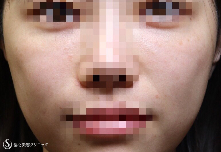 【20代女性・頬の凹み、目の下、法令線を修正】プレミアムPRP皮膚再生療法（施術後2ヶ月） Before 