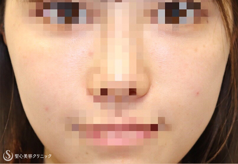 【20代女性・頬の凹み、目の下、法令線を修正】プレミアムPRP皮膚再生療法（施術後2ヶ月） After 