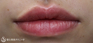 【20代女性・唇を薄くバランスよく】口唇縮小術（術後2ヶ月） Before 