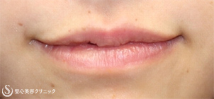 【20代女性・唇を薄くバランスよく】口唇縮小術（術後2ヶ月） After 