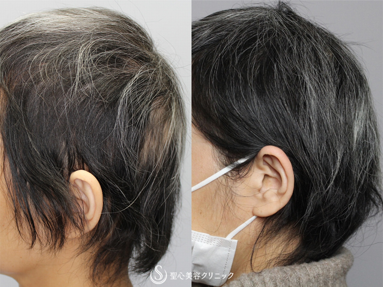 【40代女性・薄毛を改善したい】毛髪複合治療（4ヶ月後） After 