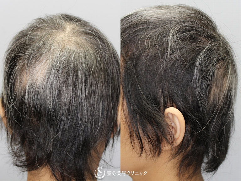 【40代女性・薄毛を改善したい】毛髪複合治療（4ヶ月後） Before 