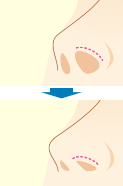 鼻孔縁下降術とは？