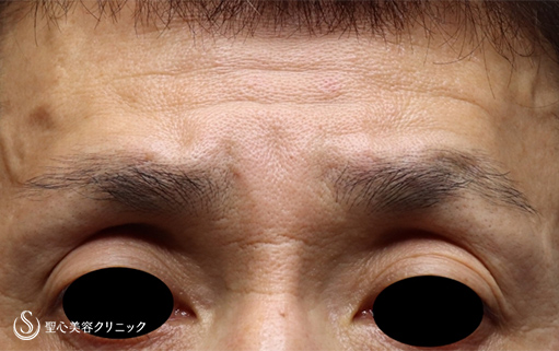 【50代男性・窪み目を解消】プレミアムPRP皮膚再生療法（2ヶ月後） Before 