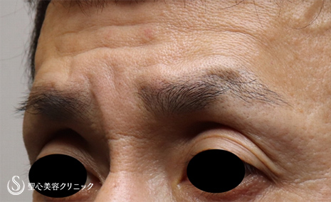 【50代男性・窪み目を解消】プレミアムPRP皮膚再生療法（2ヶ月後） Before 