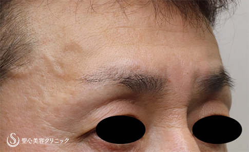 【50代男性・窪み目を解消】プレミアムPRP皮膚再生療法（2ヶ月後） After 