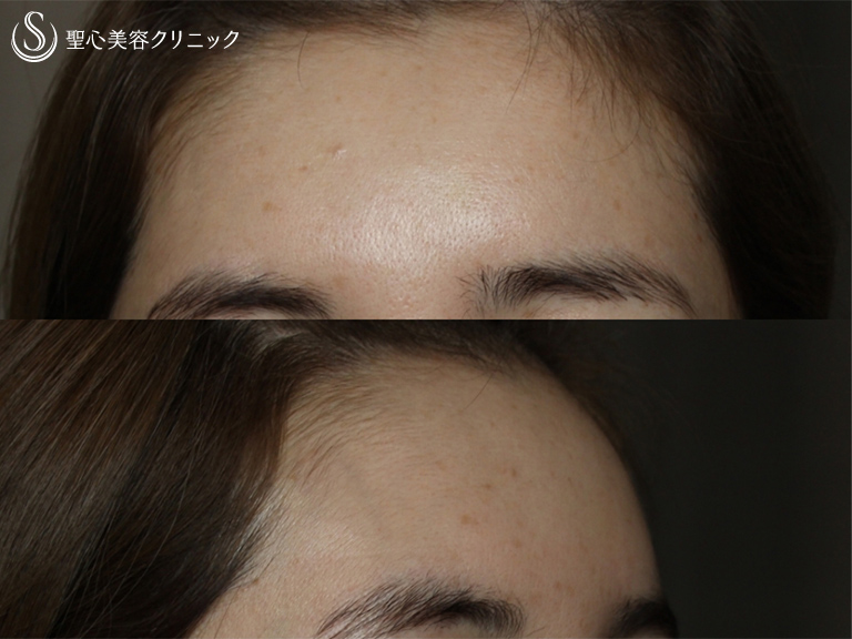 【40代女性・額をふっくらと若々しく】プレミアムPRP皮膚再生療法（処置後半年） Before 