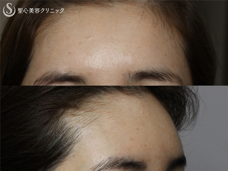【40代女性・額をふっくらと若々しく】プレミアムPRP皮膚再生療法（処置後半年） After 