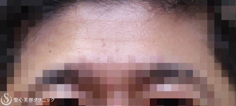 【40代男性・額のシワをスッキリ】プレミアムPRP皮膚再生療法（１ヶ月後） Before 