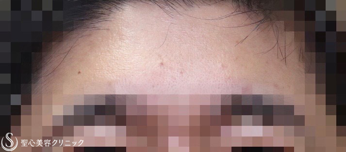 【40代男性・額のシワをスッキリ】プレミアムPRP皮膚再生療法（１ヶ月後） After 