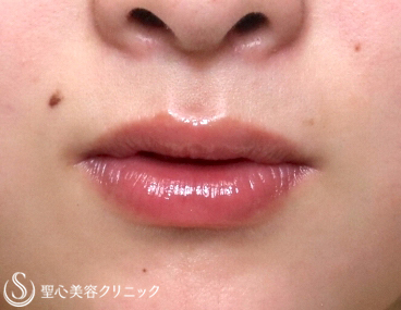 【20代女性・唇も可愛く】スマイルリップ（施術直後） Before 