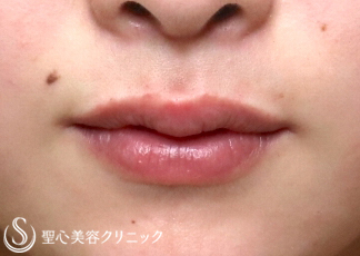 【20代女性・唇も可愛く】スマイルリップ（施術直後） After 