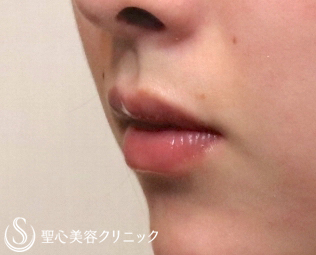 【20代女性・唇も可愛く】スマイルリップ（施術直後） Before 