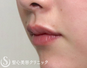 【20代女性・唇も可愛く】スマイルリップ（施術直後） After 