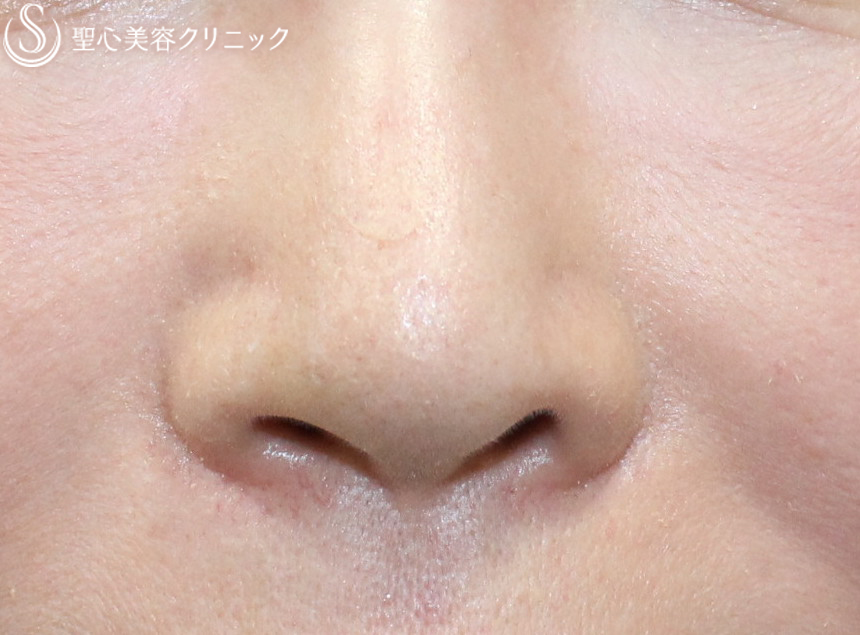 【50代女性・鼻の穴を目立ちにくく】鼻孔縁下降術（術後6日目） After 