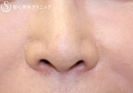 【50代女性・鼻の穴を目立ちにくく】鼻孔縁下降術（術後6日目） Before 