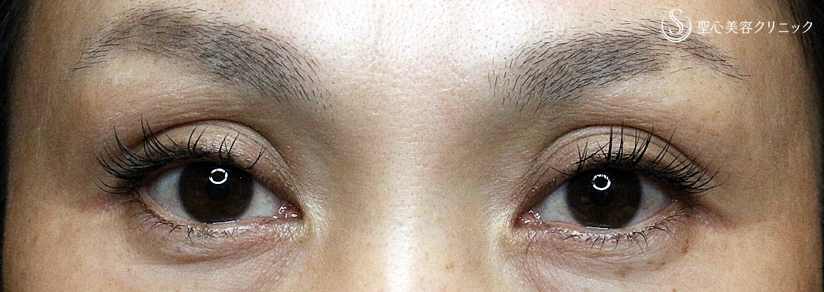 【40代女性・「くぼみ目」に第一選択】プレミアムPRP皮膚再生療法（6年2ヶ月後） Before 