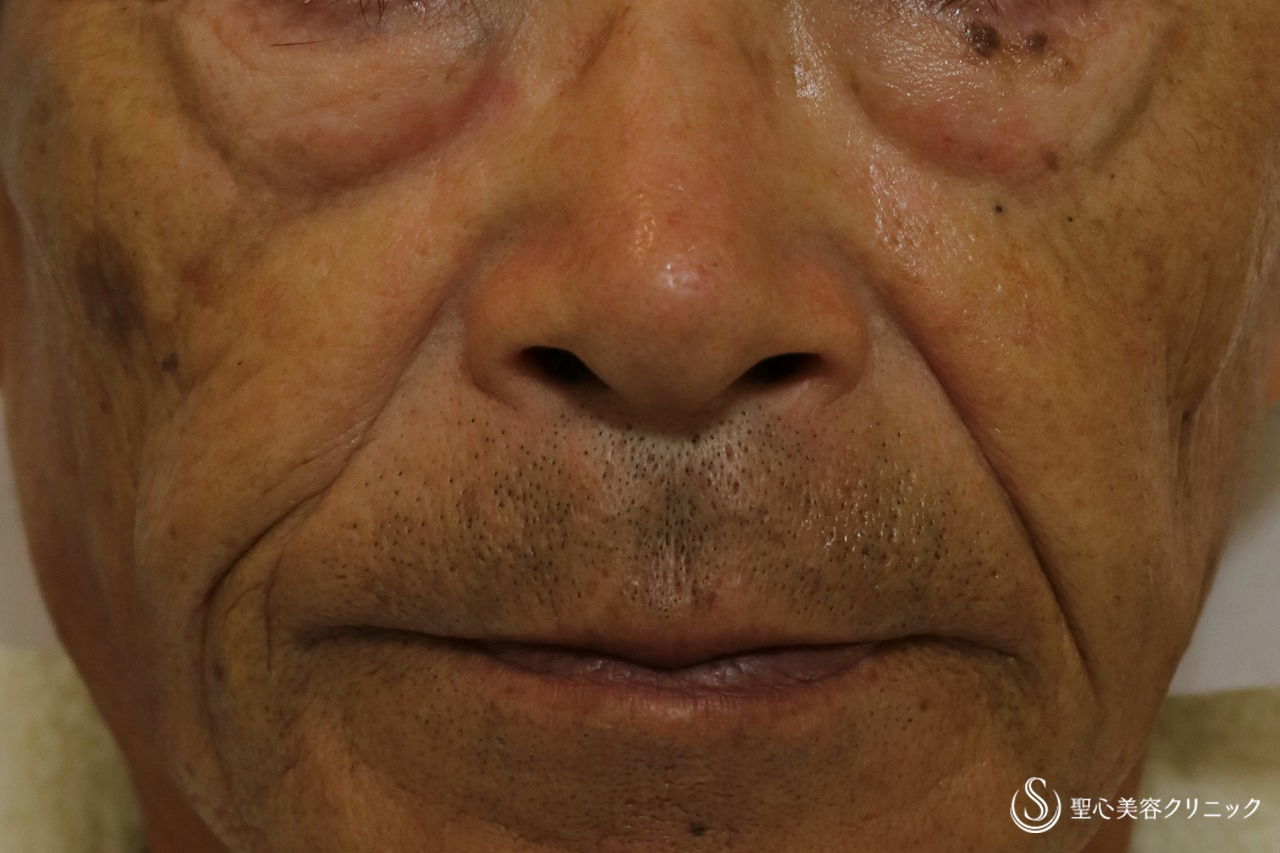 【60代男性・目の下、ほうれい線】プレミアムPRP皮膚再生療法（4か月半後） Before 