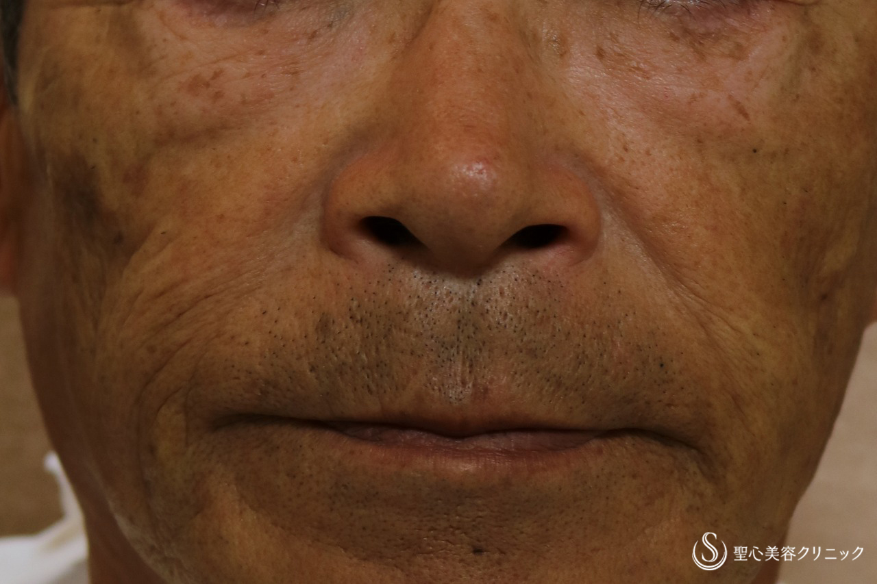 【60代男性・目の下、ほうれい線】プレミアムPRP皮膚再生療法（4か月半後） After 