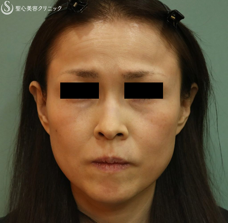 【50代女性・顔全体のやつれた印象を直したい】プレミアムPRP皮膚再生療法（1年後）アンカーマックス（2ヶ月後） Before 