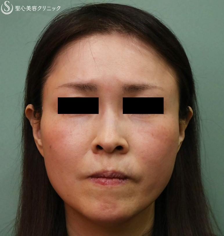 【50代女性・顔全体のやつれた印象を直したい】プレミアムPRP皮膚再生療法（1年後）アンカーマックス（2ヶ月後） After 