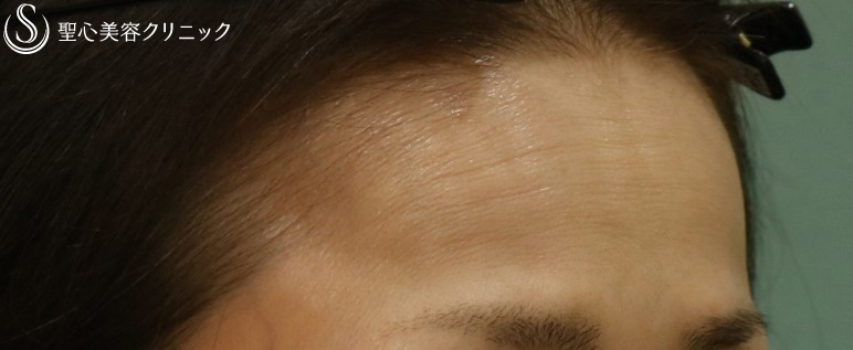 【50代女性・顔全体のやつれた印象を直したい】プレミアムPRP皮膚再生療法（1年後）アンカーマックス（2ヶ月後） Before 