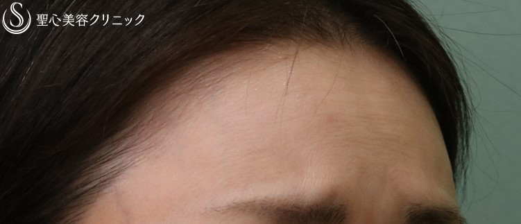 【50代女性・顔全体のやつれた印象を直したい】プレミアムPRP皮膚再生療法（1年後）アンカーマックス（2ヶ月後） After 