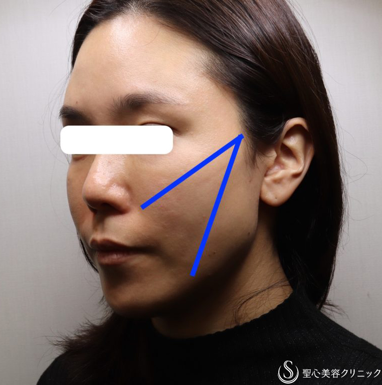 【女性・フェイスラインをすっきりと】TESSリフト（施術直後と翌日） Before 